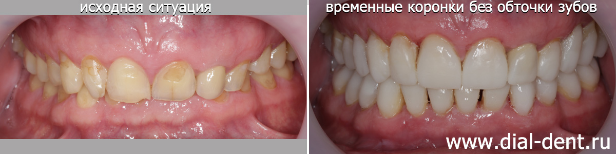 временное протезирование без обточки зубов