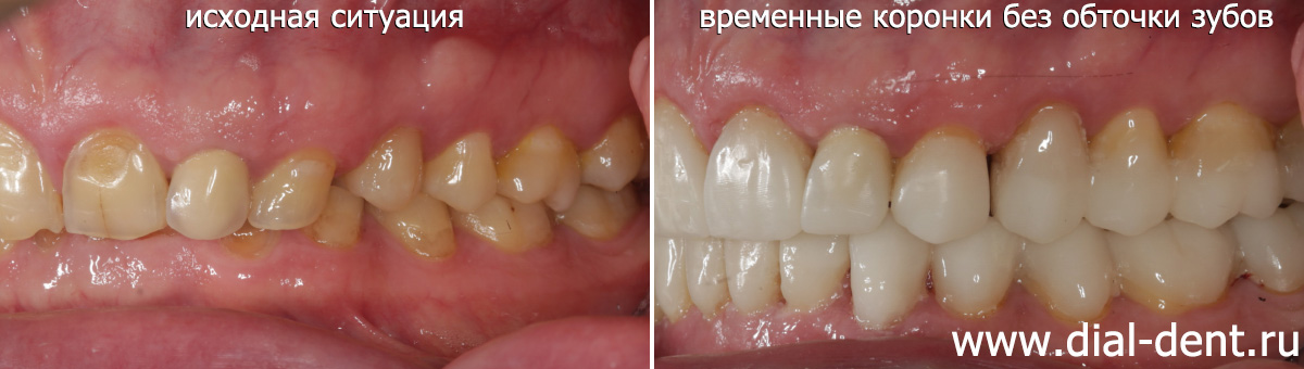 временное протезирование без обточки зубов - вид слева