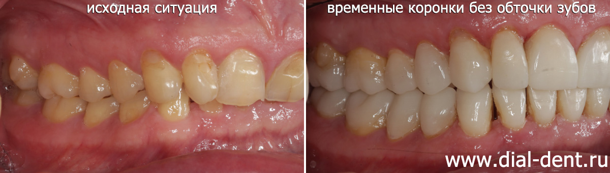 временное протезирование без обточки зубов - вид справа