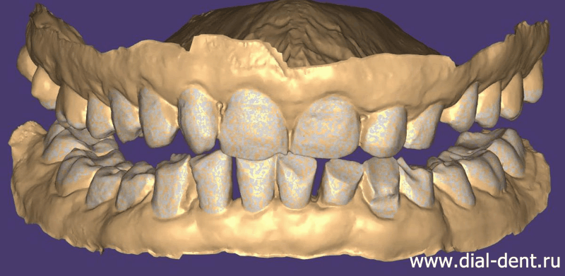 компьютерное моделирование зубных реставраций