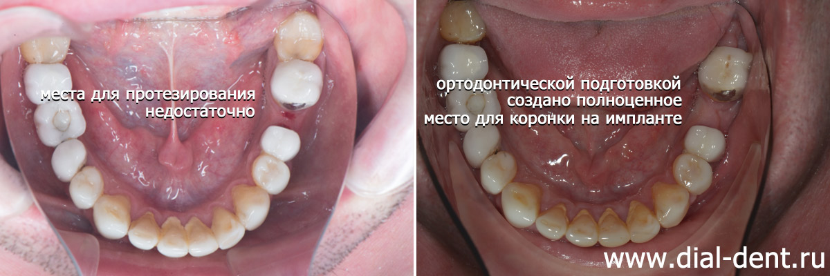 нижние зубы до и после ортодонтической подготовки