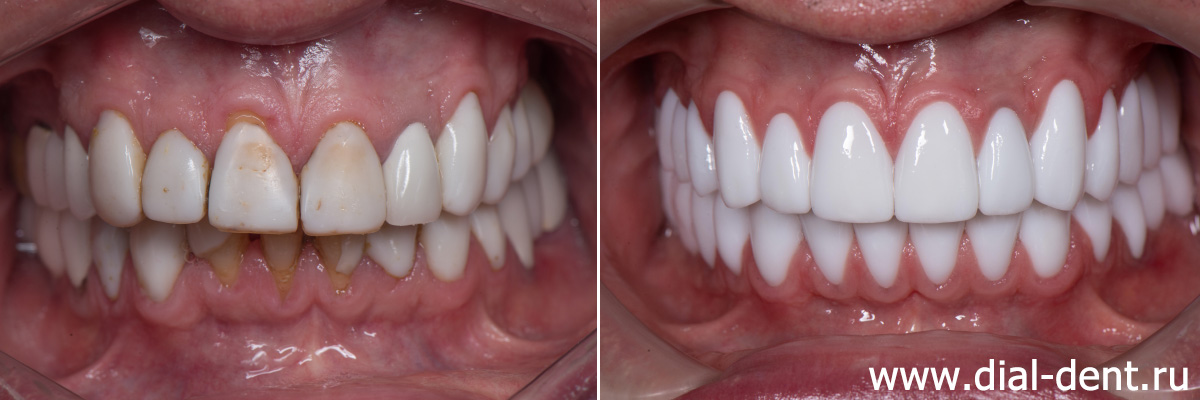 до и после протезирования зубов в Диал-Дент
