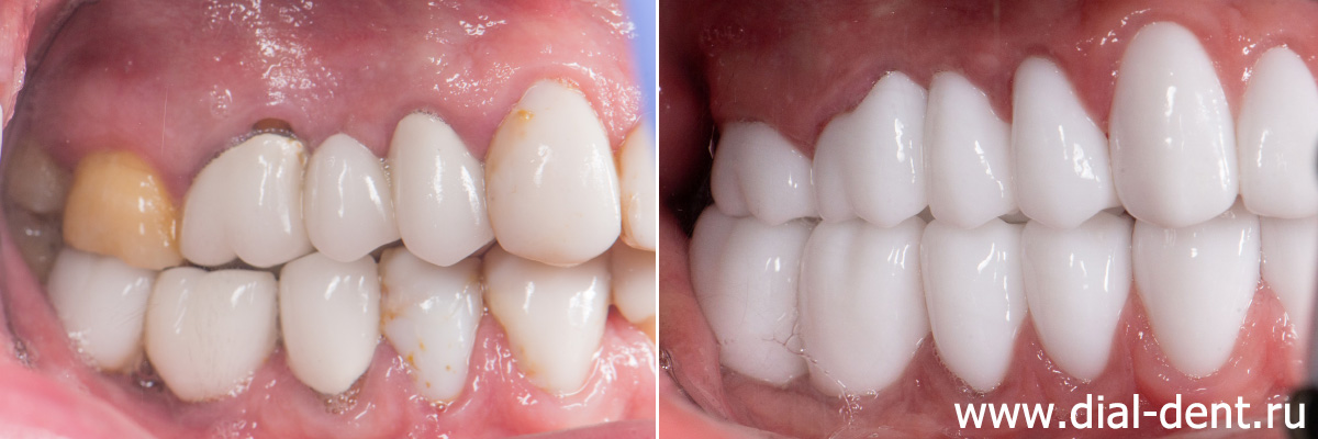до и после - вместо подвесного зуба установлен имплант и коронка