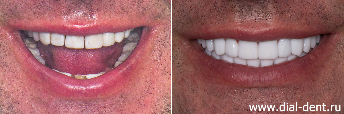 улыбка до и после протезирования зубов в Диал-Дент