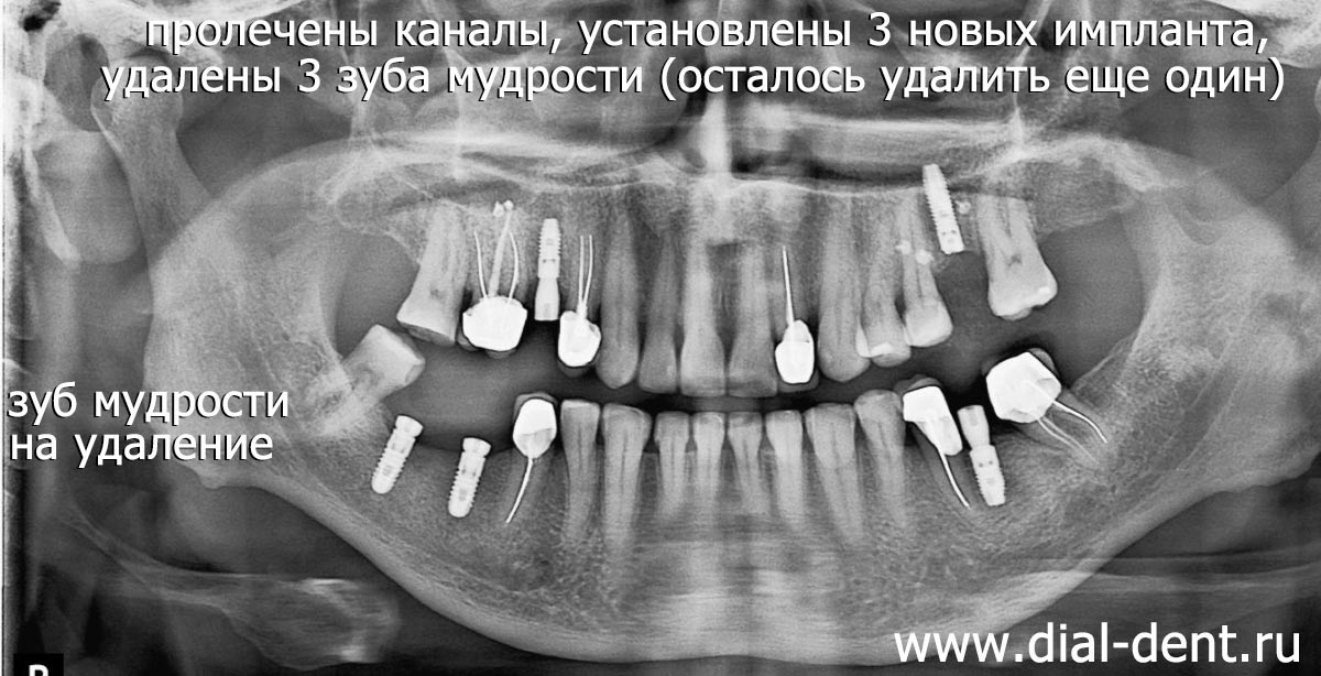 компьютерная томография зубов (фрагмент) после ортодонтии и хирургии