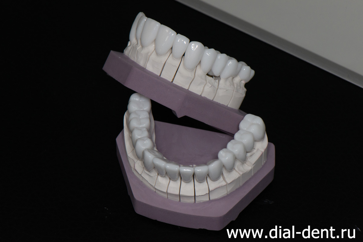 зубные коронки из диоксида циркония на все зубы на модели