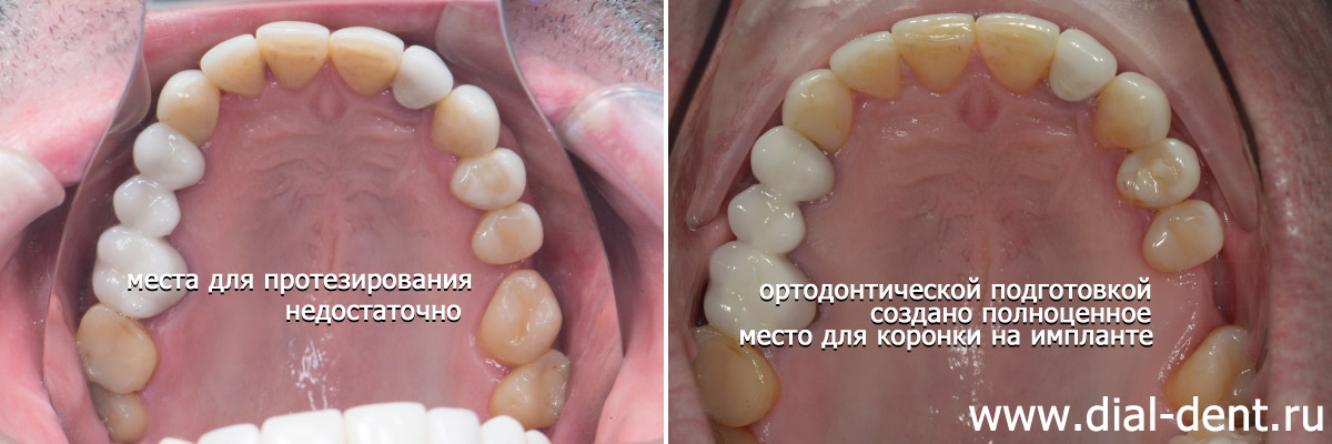 ортодонтическая подготовка на верхней челюсти