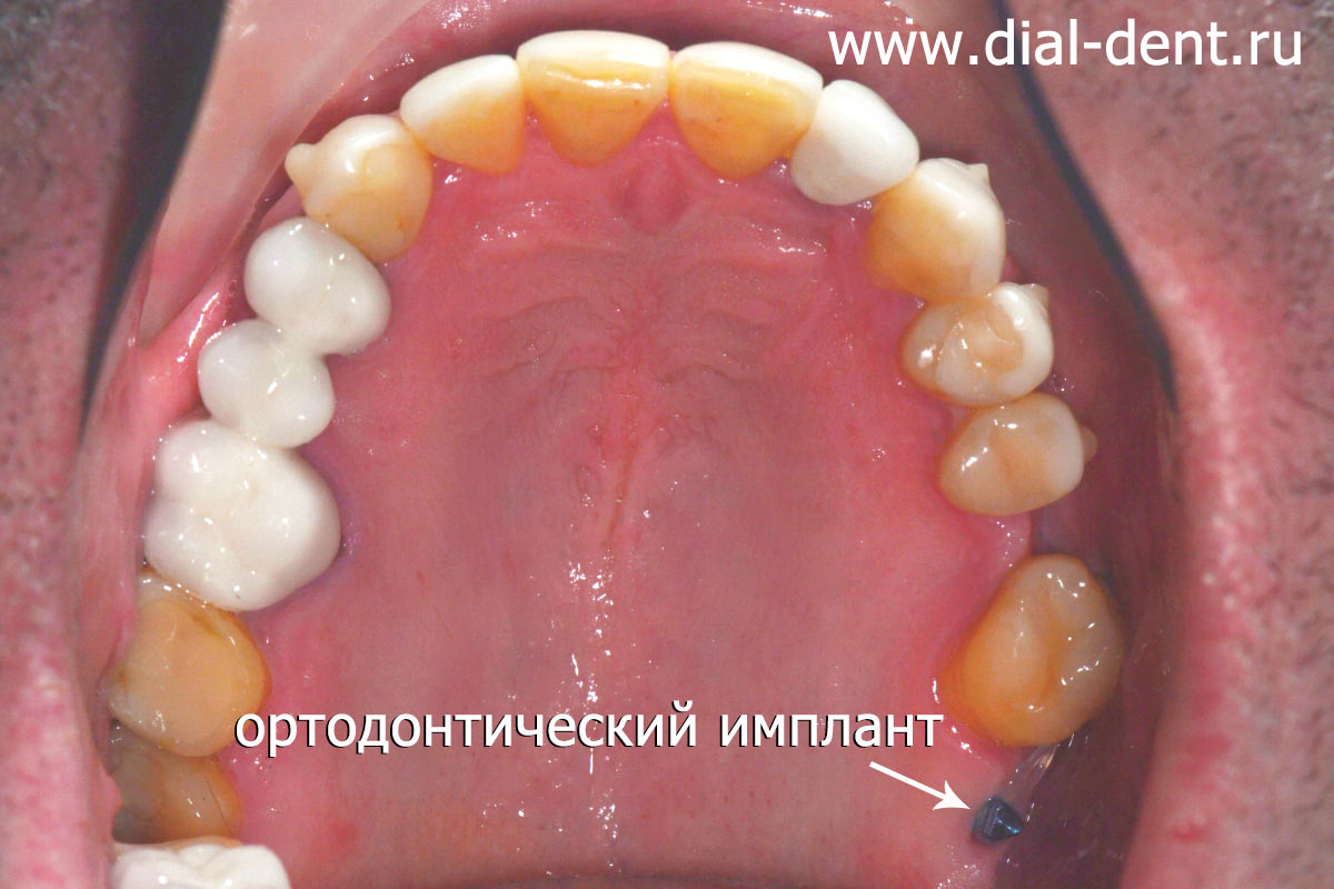 установлен ортодонтический имплант для дополнительной тяги