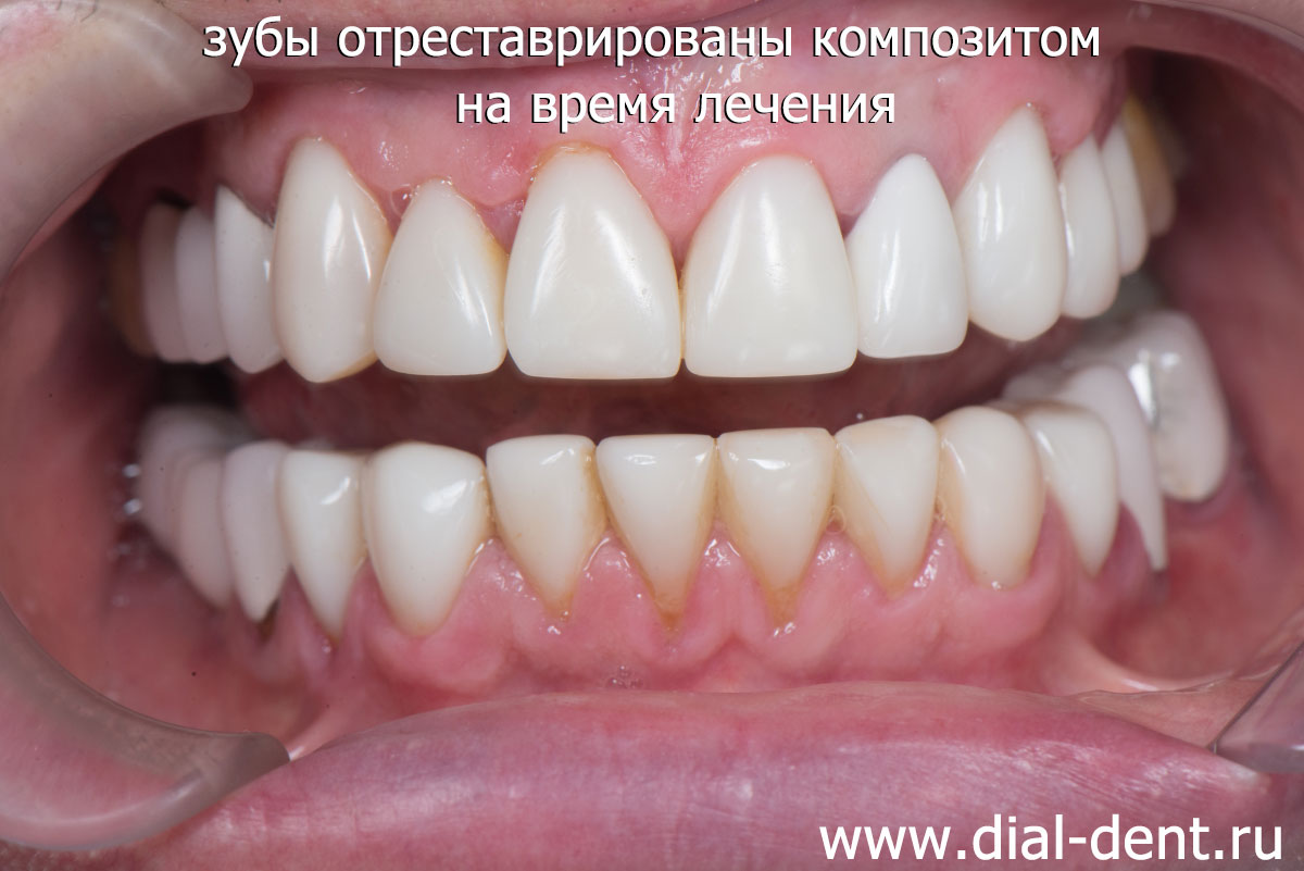 реставрация зубов композитом на время лечения