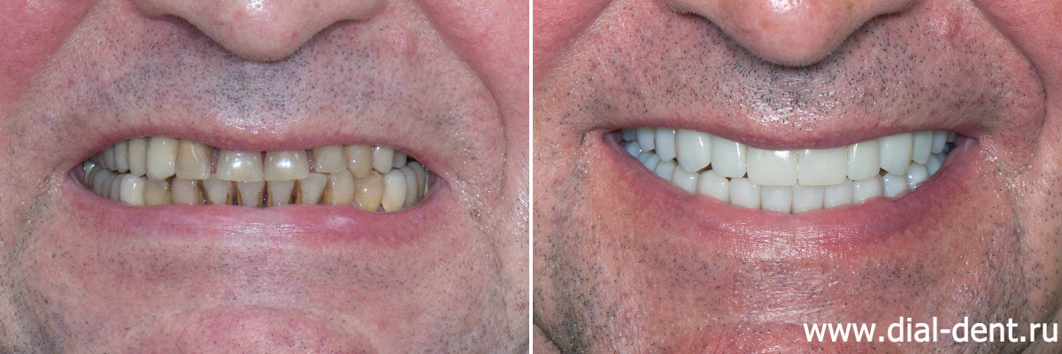 улыбка до и после протезирования зубов керамикой