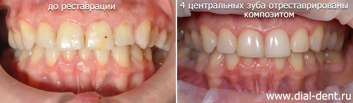 до и после реставрации зубов композитом