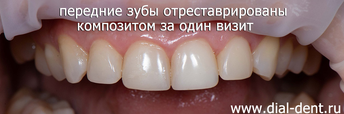 реставрация зубов композитом за один визит