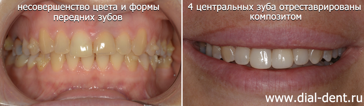 до и после реставрации передних зубов композитом
