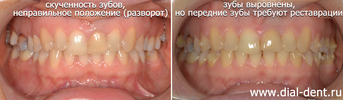 до и после ортодонтического лечения