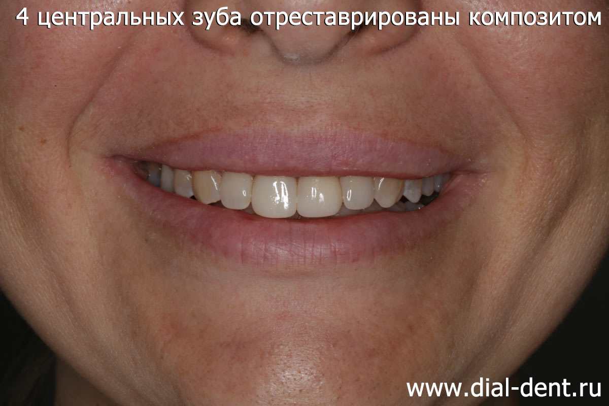 реставрация передних зубов композитом
