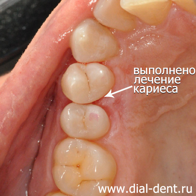 лечение кариеса зубов выполнено, зуб восстановлен пломбой
