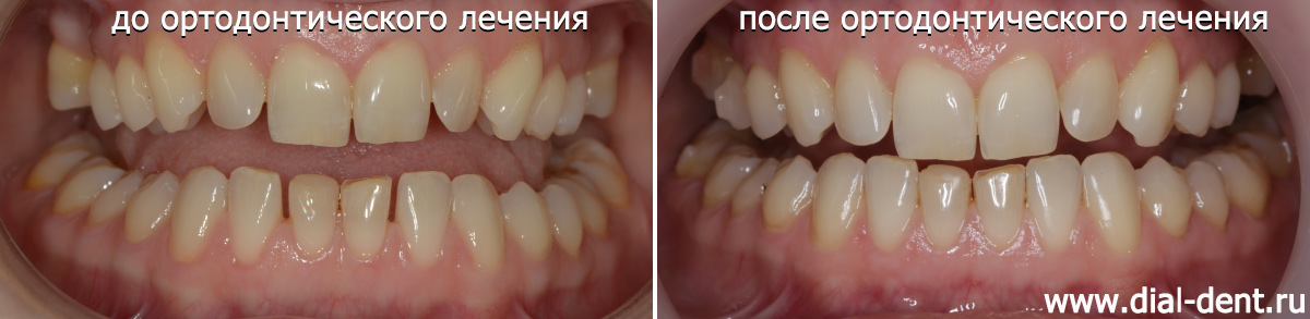 до и после ортодонтического лечения капами