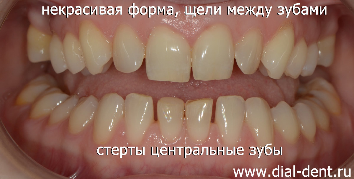 до лечения - щели между зубами, стертые зубы, неровная форма передних зубов