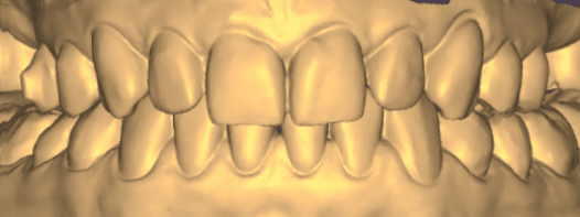 моделирование зубных реставраций (виниров)