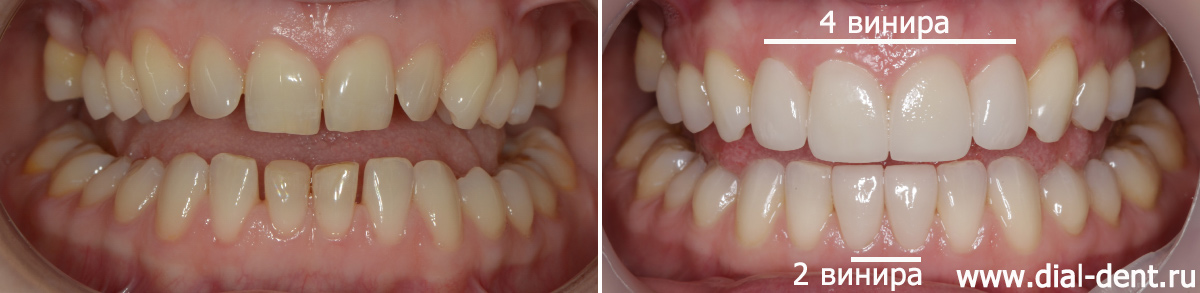 отбеливание зубов и реставрация передних зубов винирами