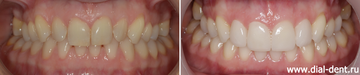 результат ортодонтической подготовки, отбеливания и реставрации зубов винирами