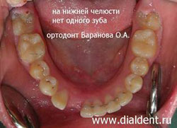 нижняя челюсть после ортодонтического лечения