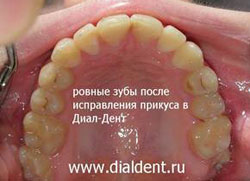 верхняя челюсть после ортодонтического лечения