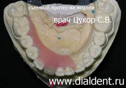 протез одного зуба для подростка на модели вид изнутри