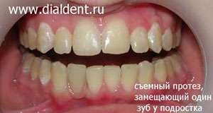 протез одного зуба установлен