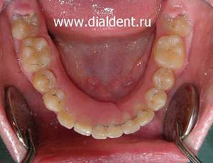 протез одного зуба установлен