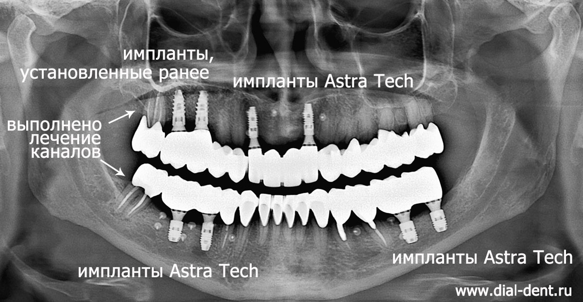 фрагмент КТ зубов после лечения