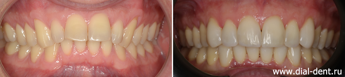 исправление прикуса и реставрация передних зубов