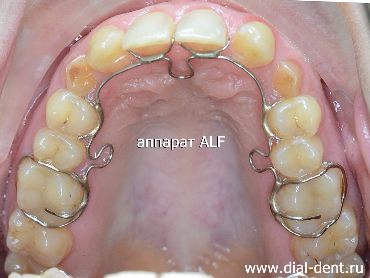 аппарат ALF на зубах