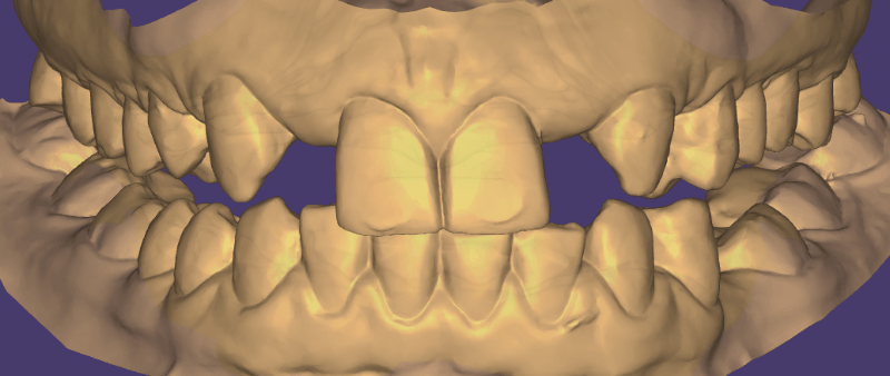сканирование зубов и моделирование зубных коронок