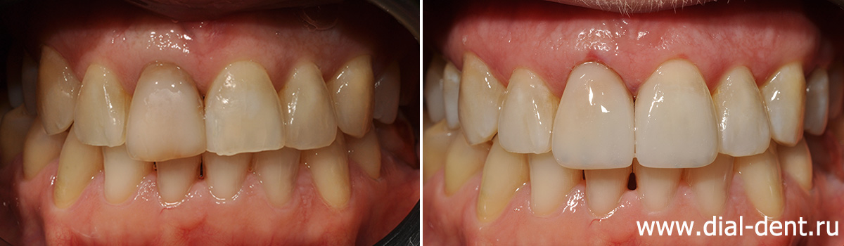 Художественная реставрация зубов: показания, виды, этапы