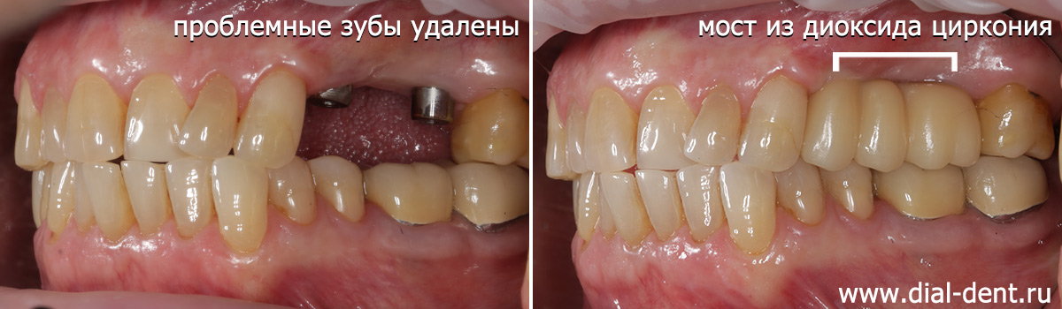 стоматологическое лечение при одонтогенном гайморите