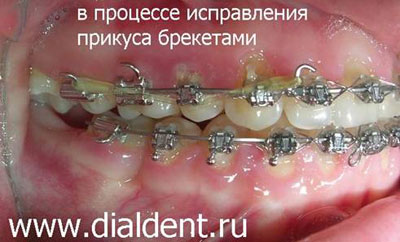 исправление прикуса и выравнивание зубов брекеты