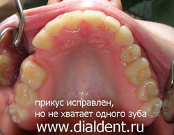 верхняя челюсть, вид изнутри после ортодонтического лечения