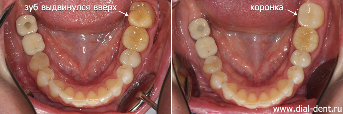нижние зубы до и после протезирования