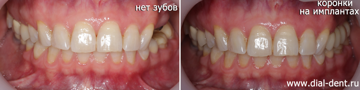 вид до и после протезирования жевательных зубов на имплантах