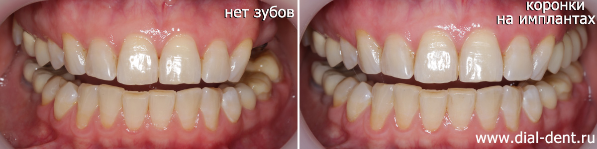 вид до и после протезирования жевательных зубов на имплантах
