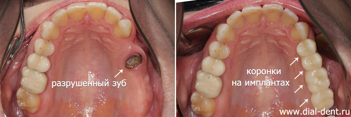 верхние зубы до и после имплантации и протезирования