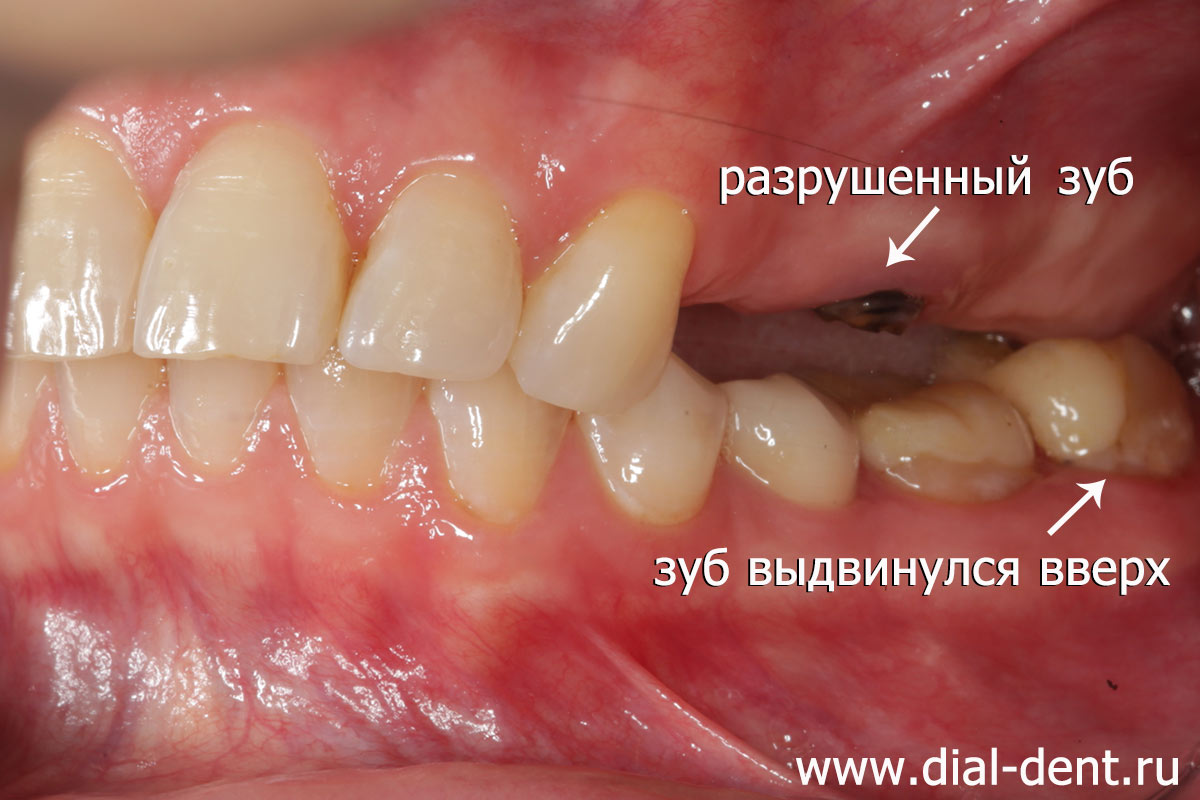 до начала лечения: остатки разрушенного зуба, нижний зуб выдвинулся до десны