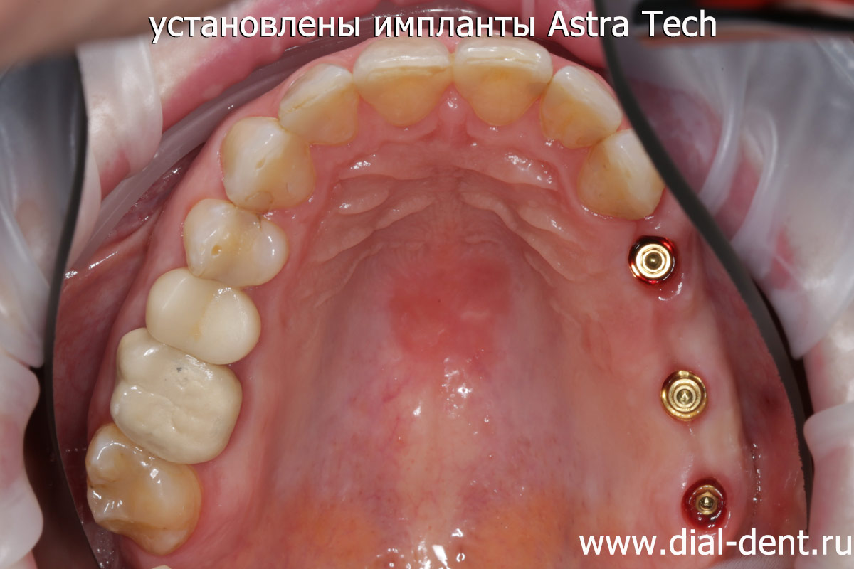 установлены зубные импланты Astra Tech