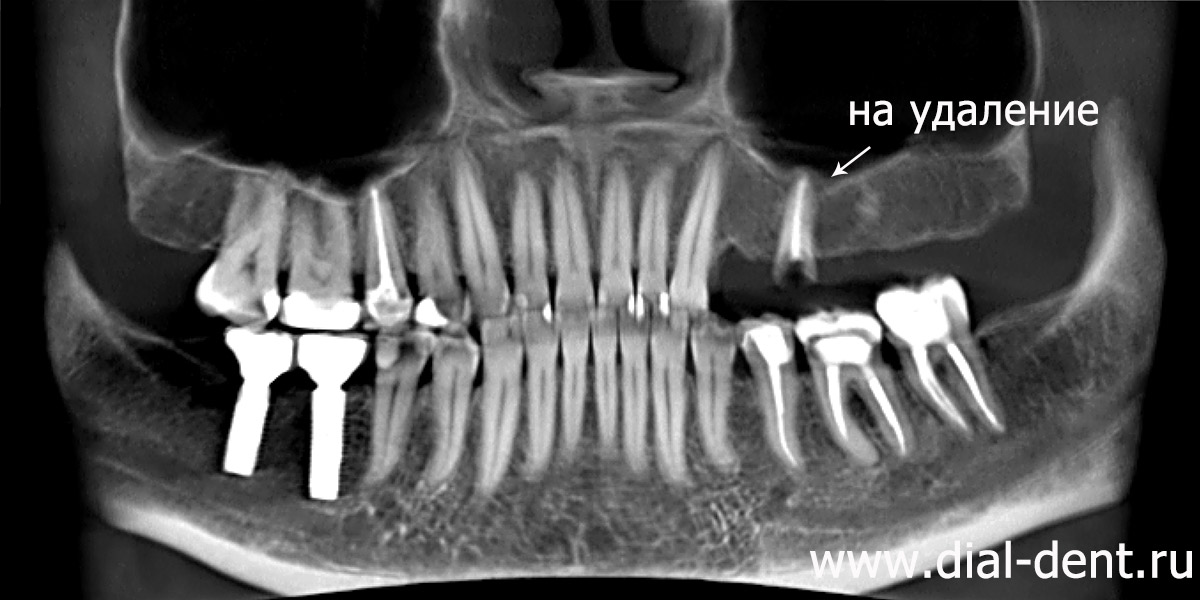фрагмент компьютерной томографии зубов до лечения