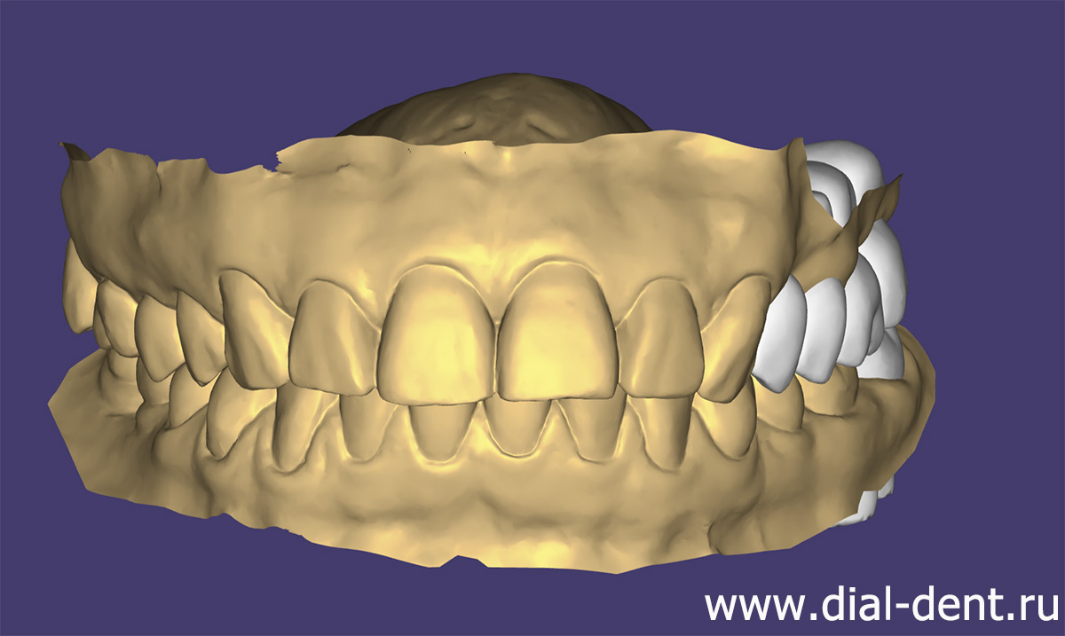 моделирование зубных коронок