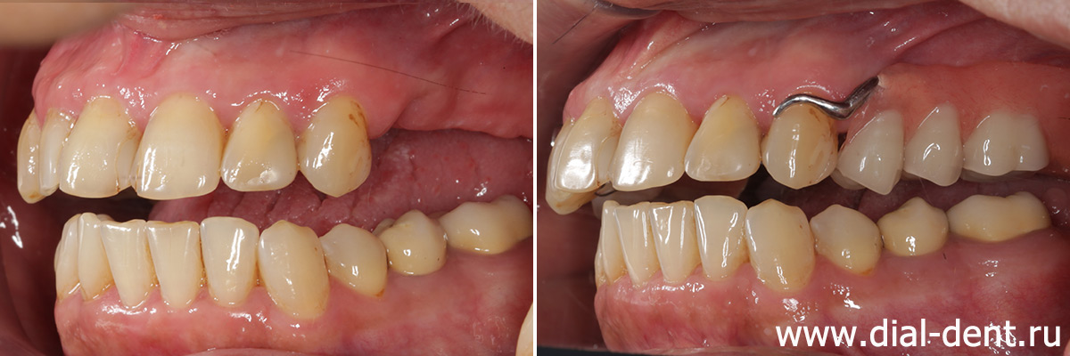 слева бюгельный протез на верхней челюсти замещает три зуба