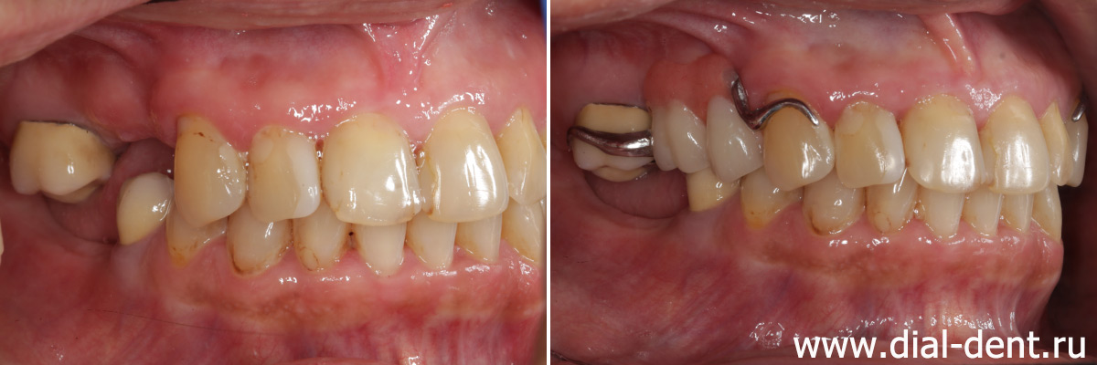 справа бюгельный протез на верхней челюсти замещает два зуба
