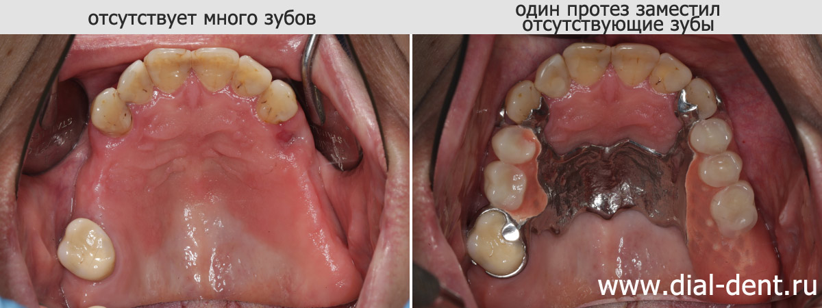 до и после протезирования бюгельным протезом на верхнюю челюсть