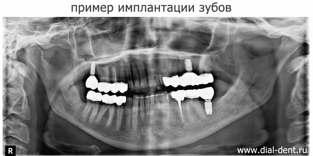 имплантация зубов и протезирование на имплантах